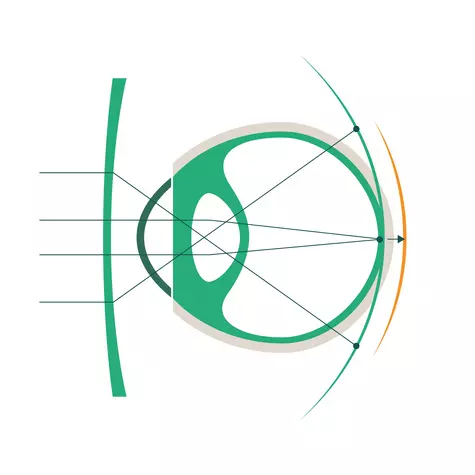 Kurzsichtiges Auge mit Einstärkenglas