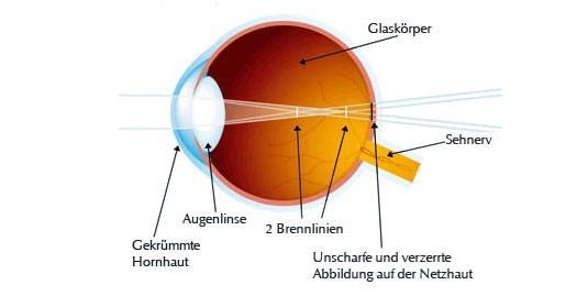 Hornhautverkrümmung