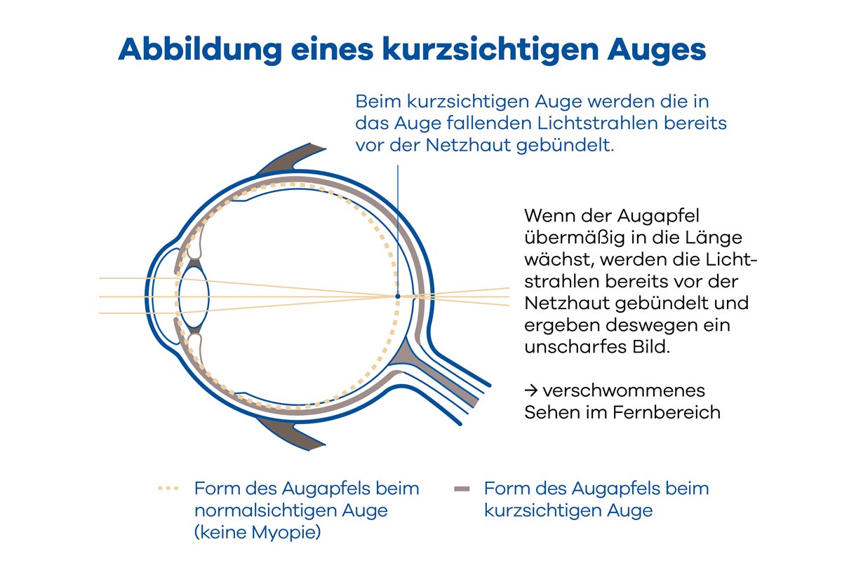 Abbildung eines kurzsichtigen Auges